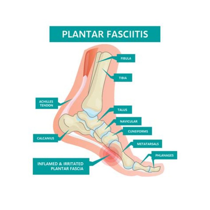 What Causes Plantar Fasciitis?